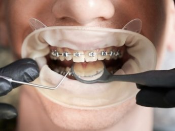 Як виправити прикус у дорослому віці: сучасні методи та можливості