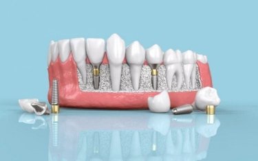 Фото 3 — Как происходит реставрация зубного ряда при помощи имплантов?