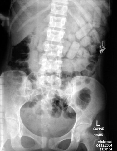 Фото 7 — 10 креативных способов использования презервативов не по назначению (ФОТО)