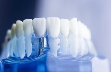 Как происходит реставрация зубного ряда при помощи имплантов?